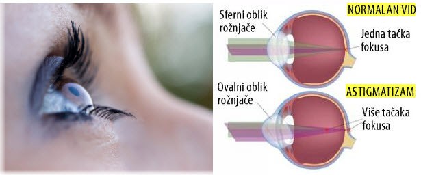 refrakterna hirurgija