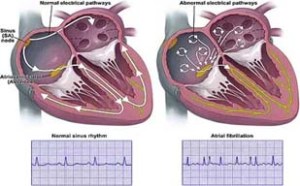 atrial fibrilation