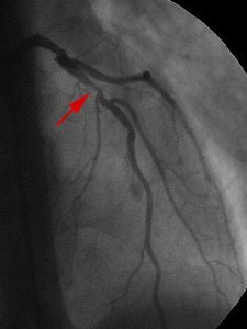 stenosis left main coronar artery